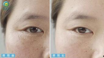 挤油脂粒视频,告别肌肤困扰