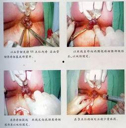 痔疮外剥内扎手术视频,痔疮外剥内扎手术全过程解析